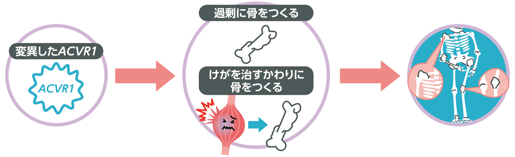 ACVR1遺伝子の変異による影響のイメージ図。変異したACVR1が過剰に骨をつくり、本来骨にならないところが骨になって体を動かしづらくなる流れを示しています。