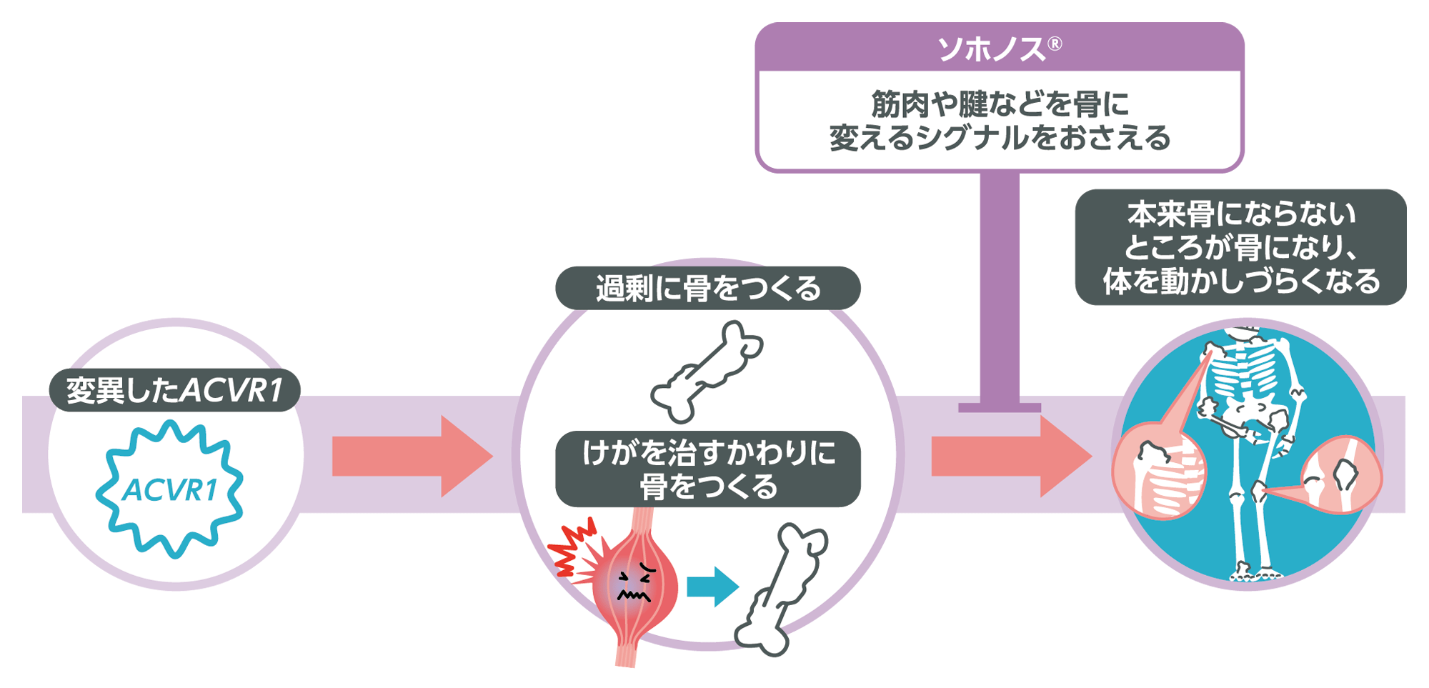 FOPの発症に関わる「変異したACVR1」が、過剰に骨をつくる・けがを治すかわりに骨をつくってしまう過程で、ソホノス®は筋肉や腱などを骨に変えるシグナルをおさえ、本来骨にならないところが骨になるのを防ぐはたらきをします。